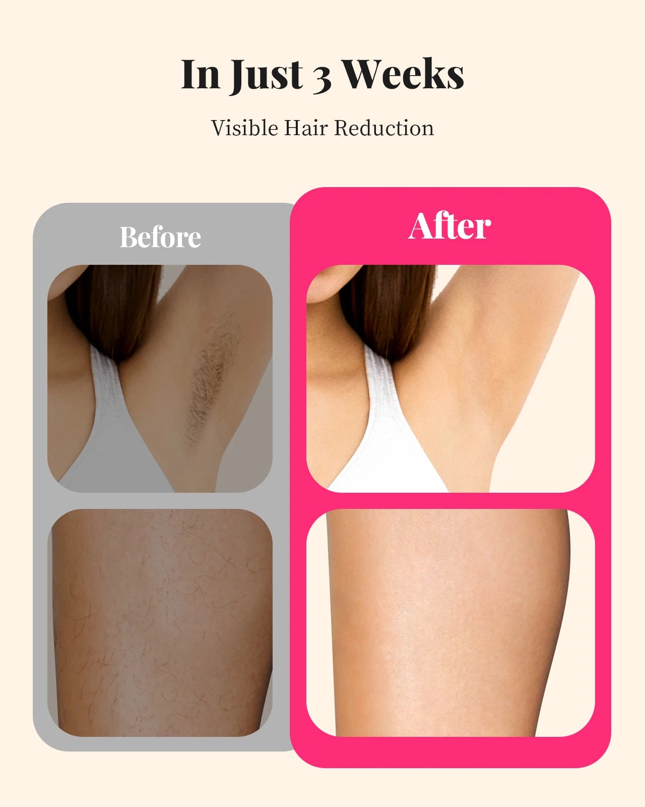 Flashes IPL Hair Removal Body Bikini and Facial Areas Painless Permanent
